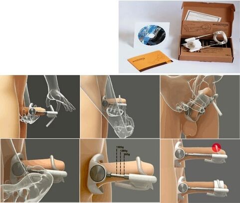 Ampliación do pene mediante un extensor