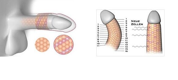 Resultado da cirurxía de ampliación do pene