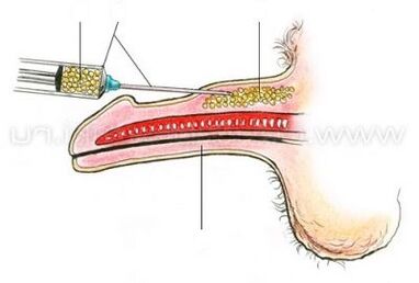 aumento do pene por inxección
