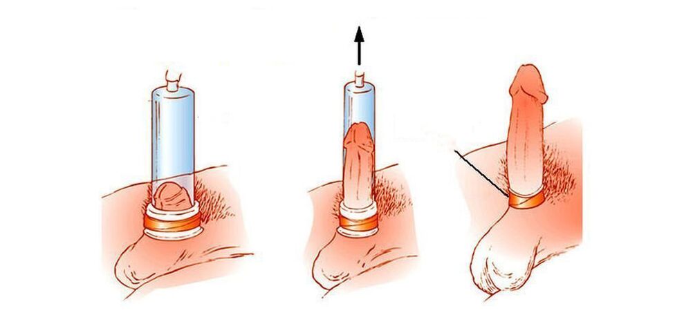 Como funciona unha bomba de baleiro do pene